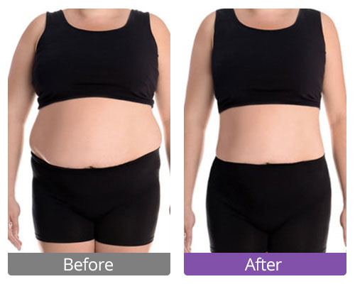 Stomach ultrasonic cavitation treatment effect comparison chart